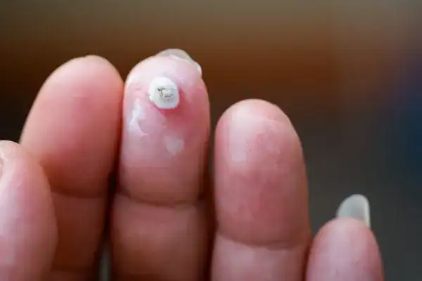 Image of white wart before cryopen treatment Royal Leamington Spa