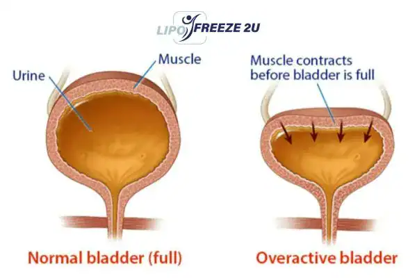 diagram of overactive bladder treatment Royal Leamington Spa