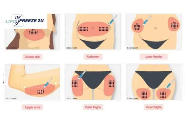 Benefits of Choosing Aqualyx for Fat Reduction Royal Leamington Spa