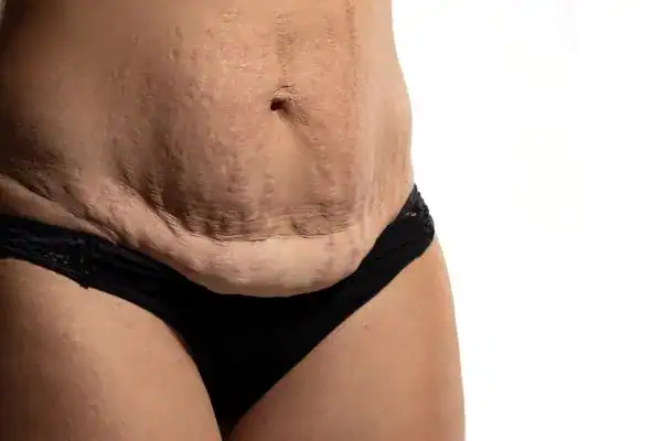 loose skin after weight loss injections Royal Leamington Spa