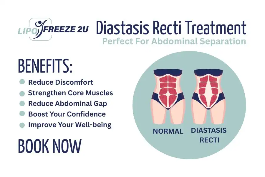 Benefits of body toning treatment Royal Leamington Spa for Diastasis recti