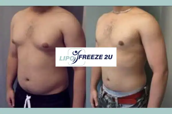 How Long Does It Take to See Results Royal Leamington Spa?