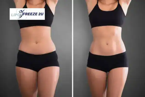 How Can LIPO FREEZE 2U Support Your Post-Pregnancy Body Recovery Royal Leamington Spa?