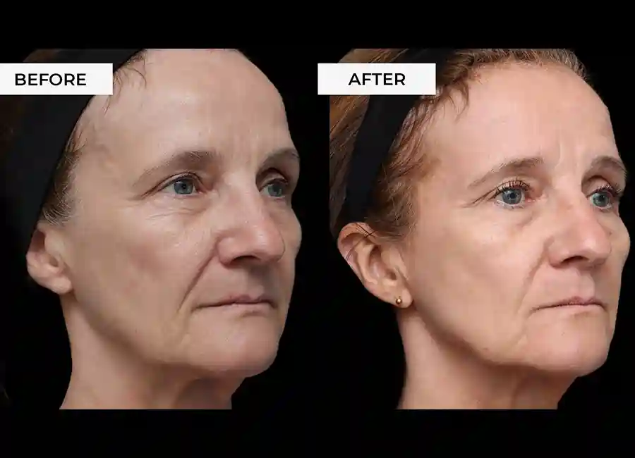 How Many RF Microneedling Sessions Will You Need to See a Difference Royal Leamington Spa?