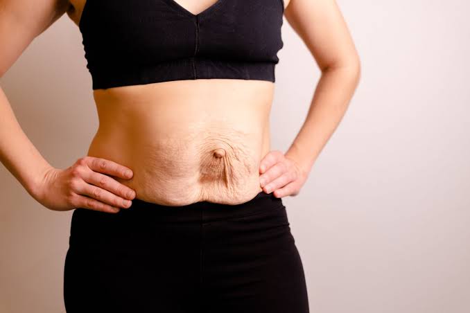 Is Surgery Really the Only Way to Repair Diastasis Recti Royal Leamington Spa?