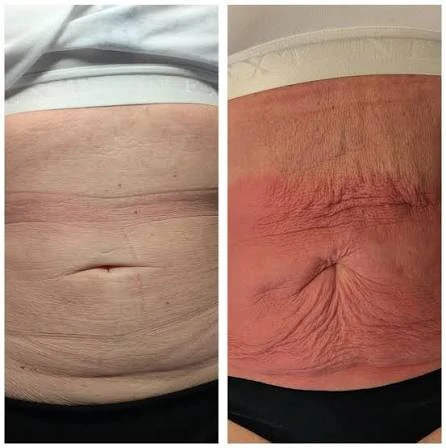 How Does RF Microneedling Improve Crepey, Thin and Uneven Skin Texture Royal Leamington Spa?