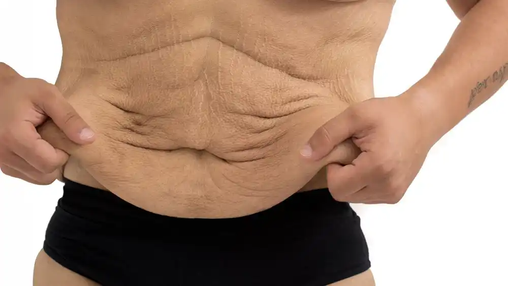 Why Does Weight Loss Medication Leave Some People With Loose or Sagging Skin Royal Leamington Spa?